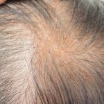 zinc deficiency hair loss