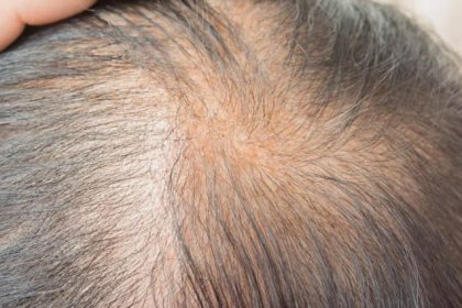 zinc deficiency hair loss