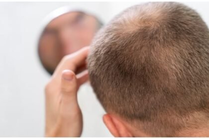 up:-आपका-खून-दिलाएगा-गंजेपन-से-छुटकारा,-अब-कोई-सर्जरी-नहीं…-बालों-को-दोबारा-उगाने-के-लिए-प्लाज्मा-थेरेपी