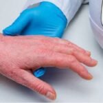 health-news:-गंभीर-बीमारी-है-सोरायसिस,-त्वचा-से-उतरते-हैं-आलू-की-तरह-छिलके;-सर्दी-में-इन-बातों-का-रखें-ध्यान