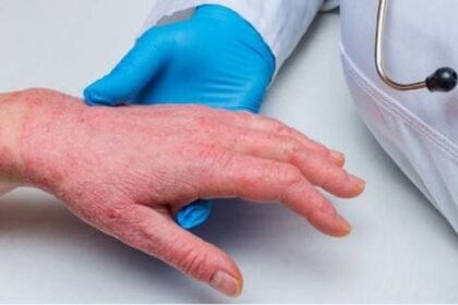 health-news:-गंभीर-बीमारी-है-सोरायसिस,-त्वचा-से-उतरते-हैं-आलू-की-तरह-छिलके;-सर्दी-में-इन-बातों-का-रखें-ध्यान
