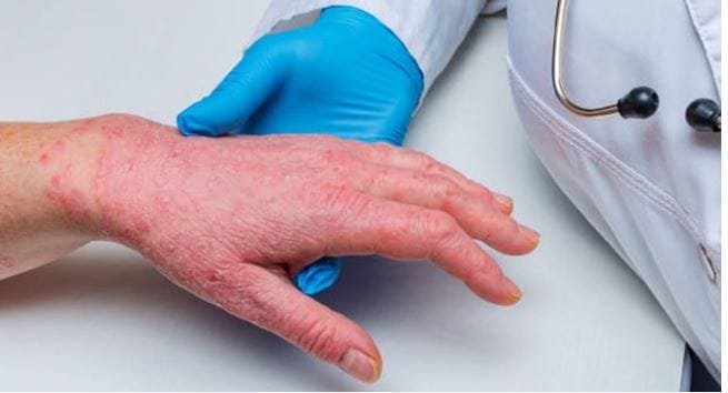 health-news:-गंभीर-बीमारी-है-सोरायसिस,-त्वचा-से-उतरते-हैं-आलू-की-तरह-छिलके;-सर्दी-में-इन-बातों-का-रखें-ध्यान