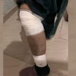 lucknow:-कुत्तों-ने-दौड़ाकर-महिला-पर-किया-हमला,-पैर-का-मांस-नोचा-डाला