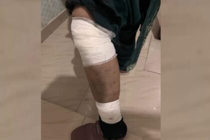 lucknow:-कुत्तों-ने-दौड़ाकर-महिला-पर-किया-हमला,-पैर-का-मांस-नोचा-डाला